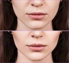 botox lippen voor en na