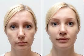 huid verbeteren gezicht