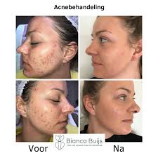 huidverbetering acne