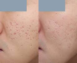 acne behandeling laser