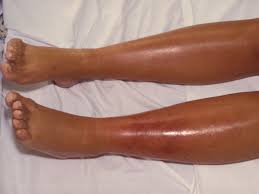 cellulitis