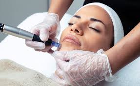 microneedling