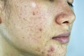 gezichtsbehandeling acne