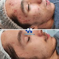 peeling acne