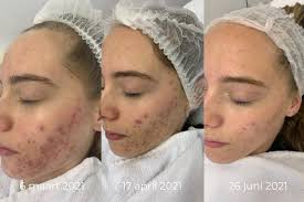 chemische peeling acne