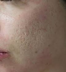 acne littekens laseren