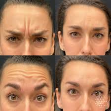 botox en filler