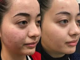 acne peel mesoestetic