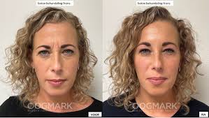 botox en fillers voor en na