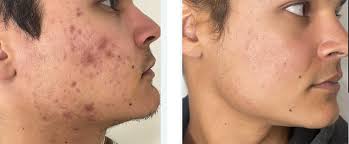 chemische peeling voor en na acne