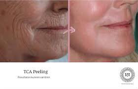 tca peeling prijs