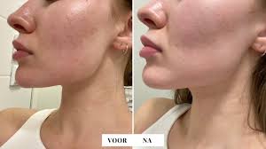 peeling acne littekens