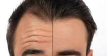 fillers of botox fronsrimpel