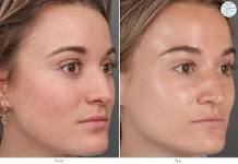 huid peeling acne
