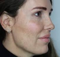 tca peeling pigmentvlekken