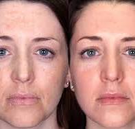 medische peeling voor en na