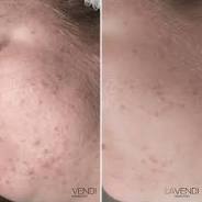 neoderma kruidenpeeling
