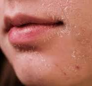 rode huid na peeling