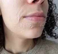 tca peeling dag 3
