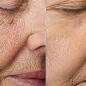 fruitzuur peeling gezicht
