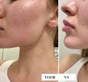 diepe peeling gezicht