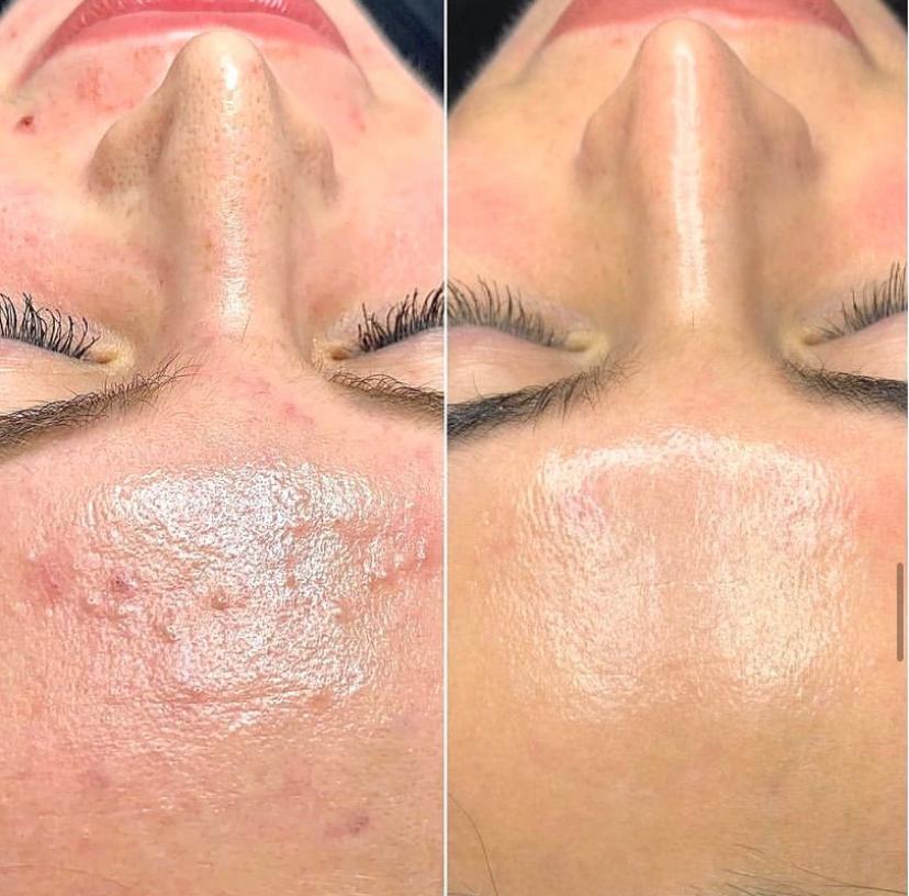 biorepeelcl3 peeling