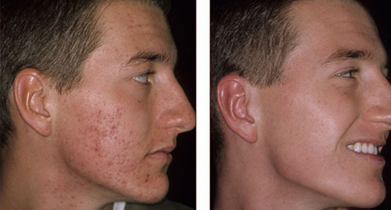 chemische peeling acne littekens
