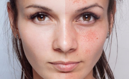 chemische peeling benen