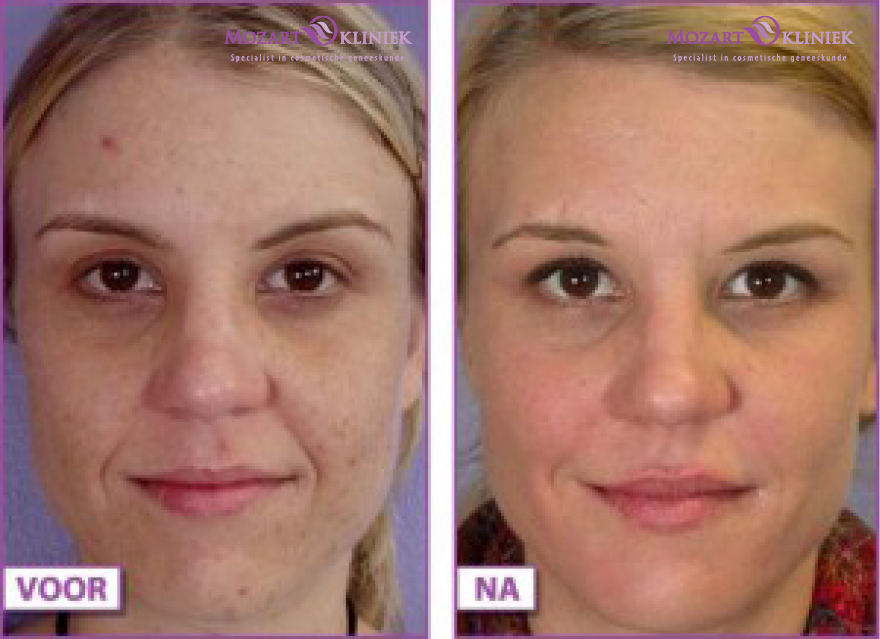 chemische peeling nadelen