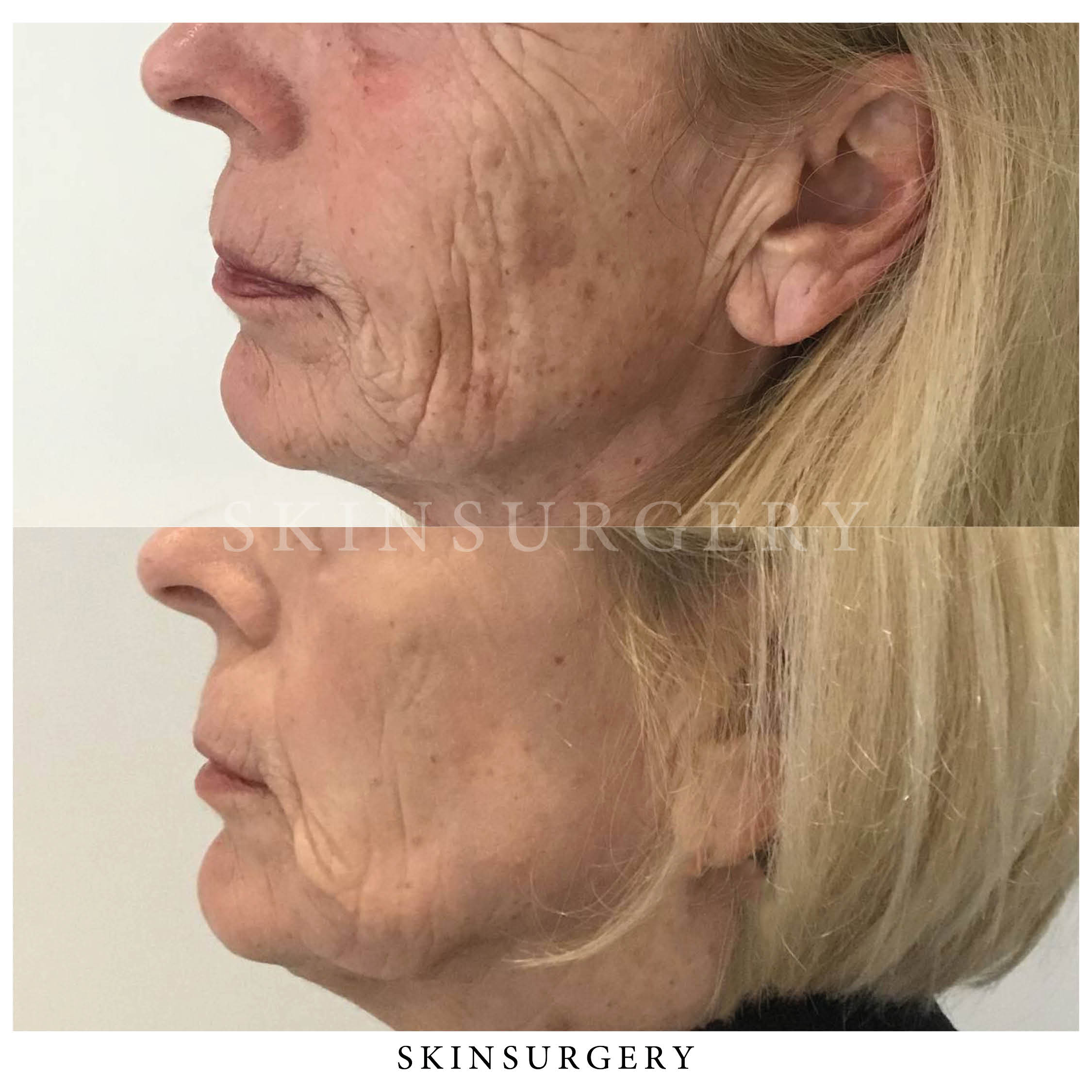 chemische peeling pigment