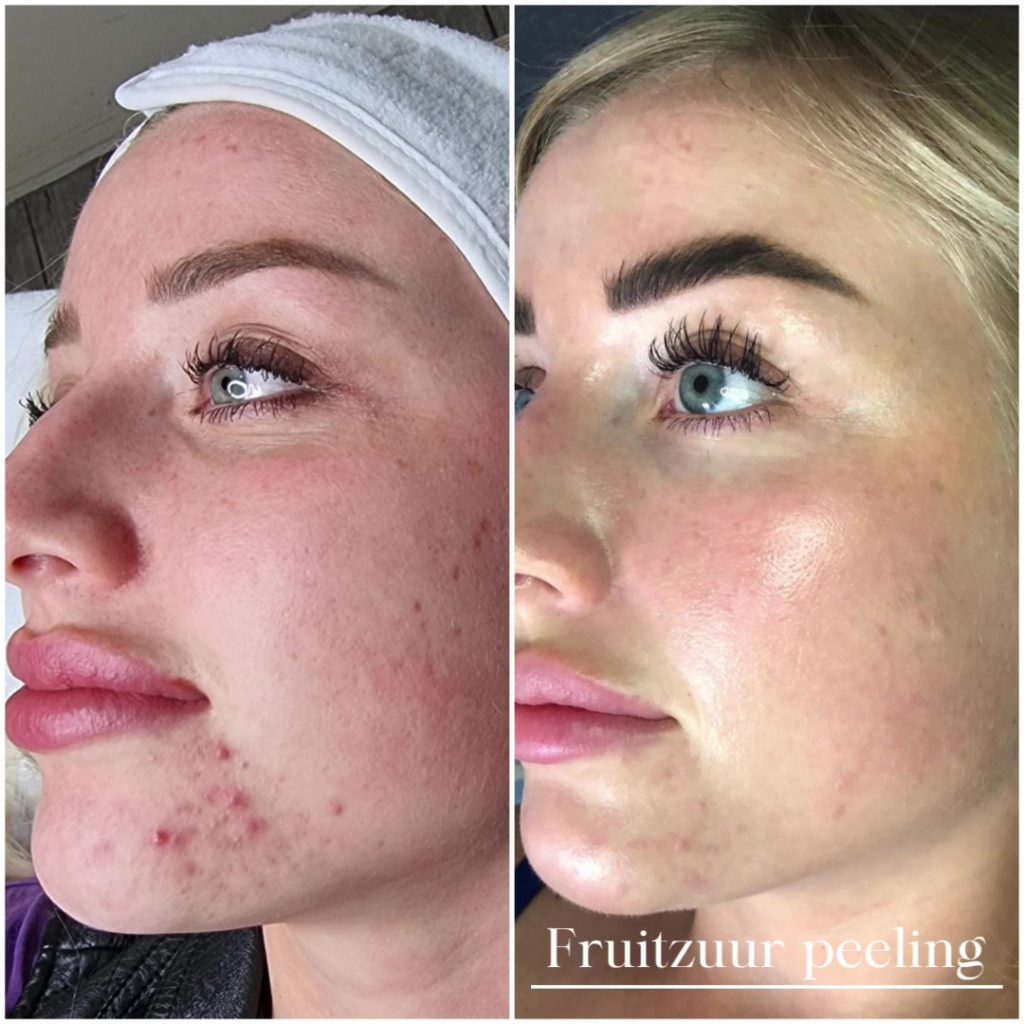 droge huid na peeling