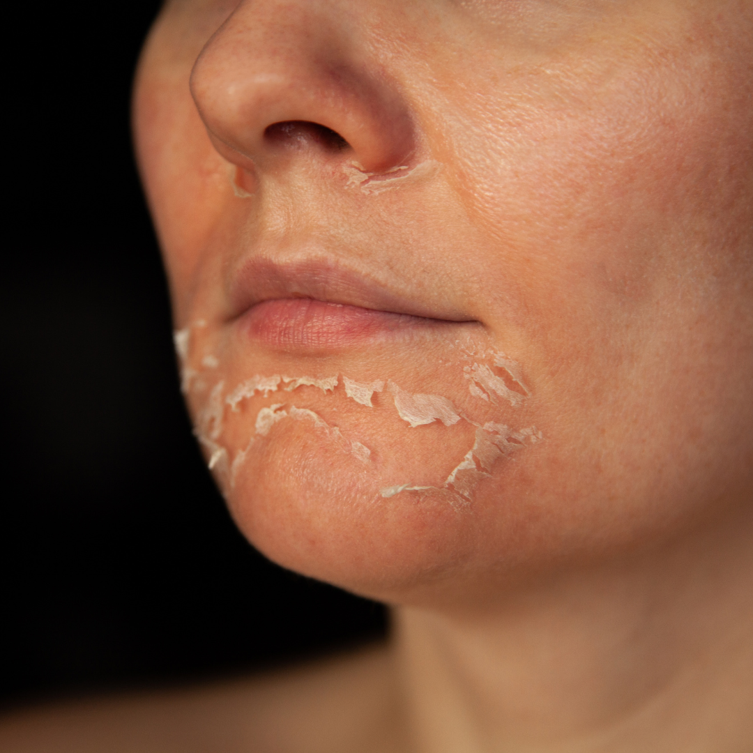 is peeling goed voor je huid