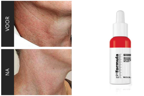 oppervlakkige peeling