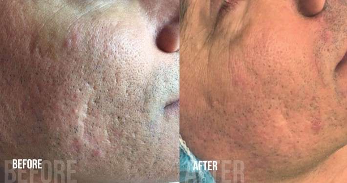 peeling acne littekens thuis