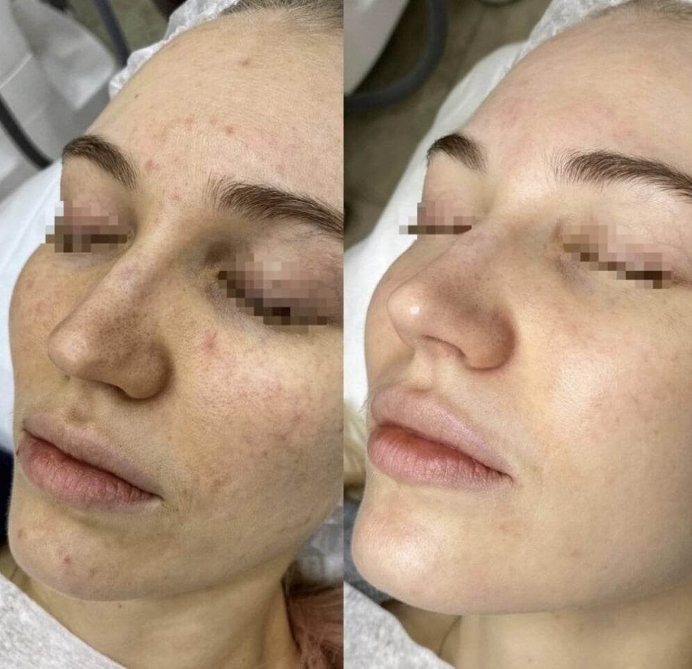 peeling behandeling gezicht