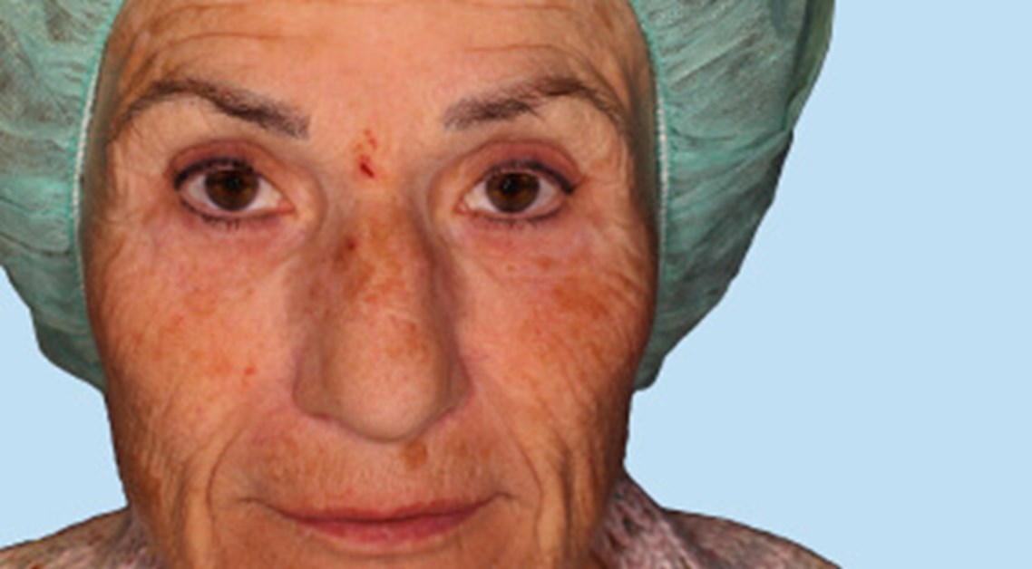 peeling velthuis kliniek