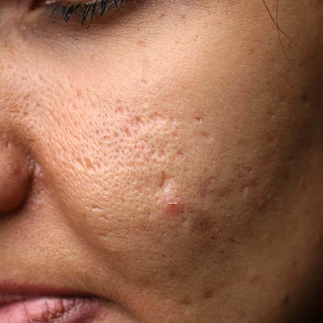 peeling voor acne littekens