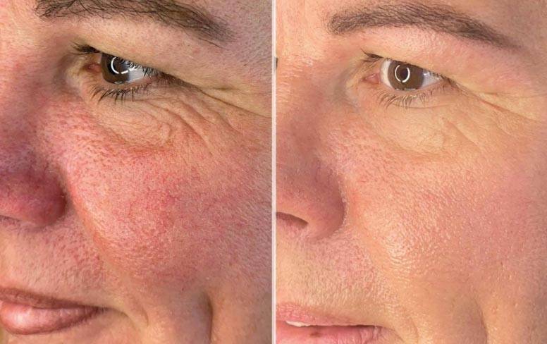 chemische peeling pigmentvlekken