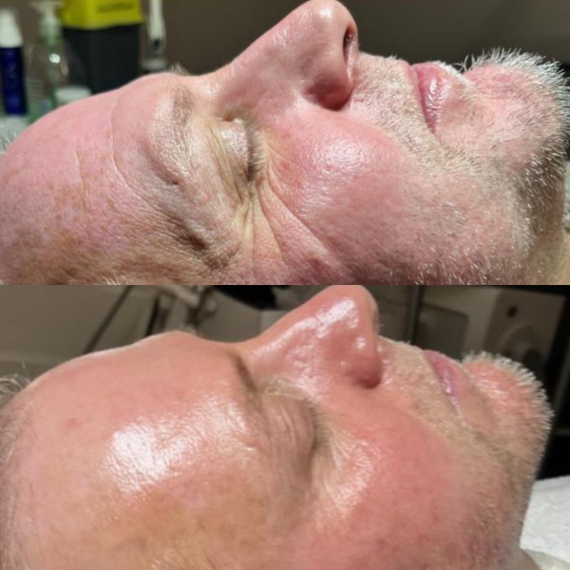 chemische peeling thuisgebruik