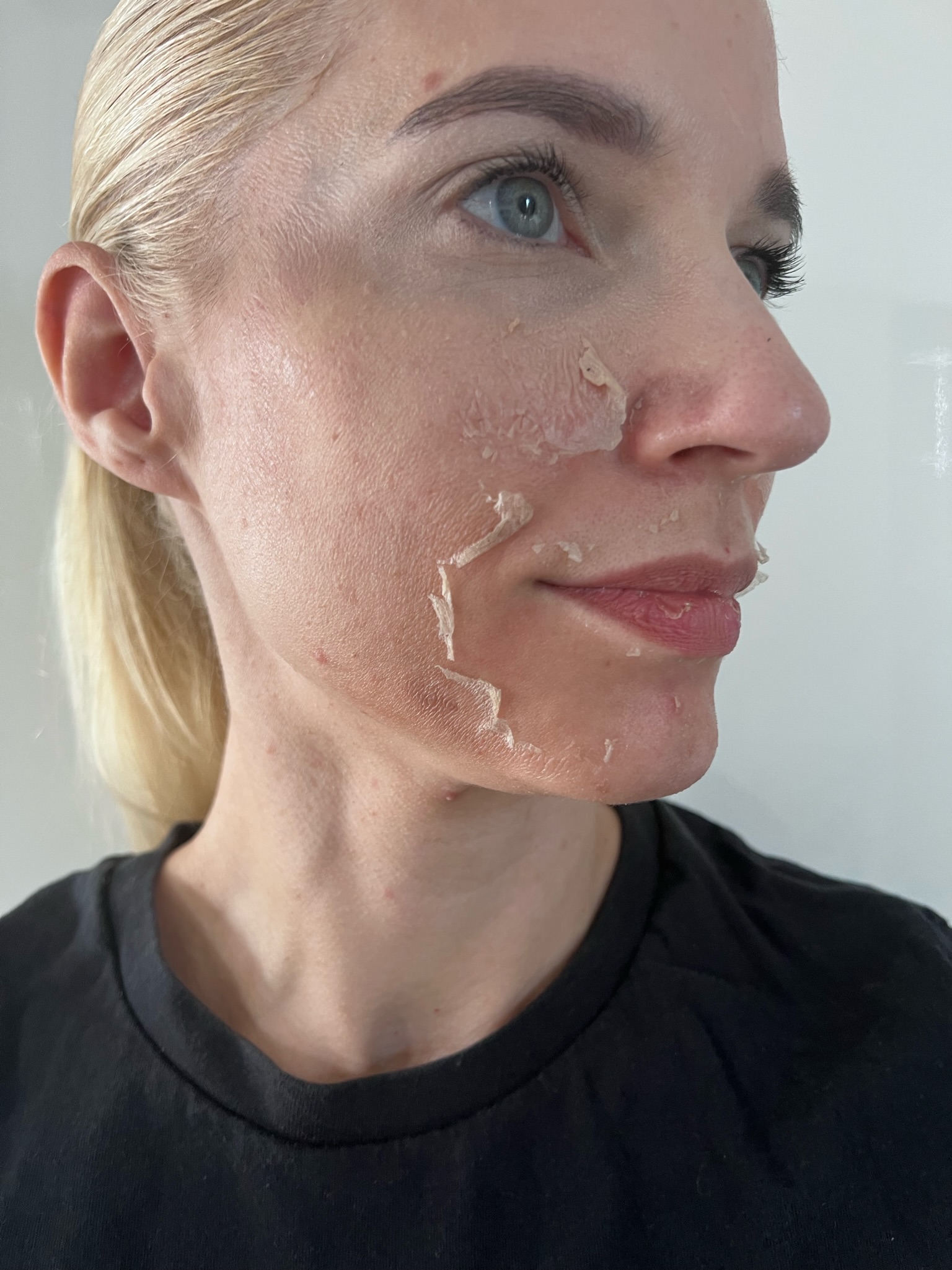 peeling donkere huid