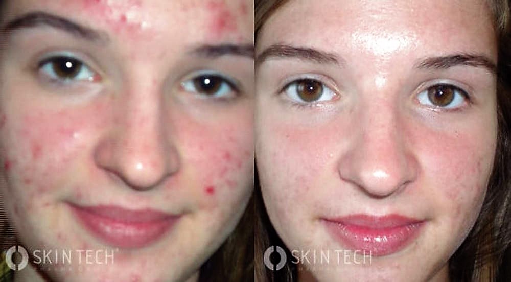 peeling gezicht acne