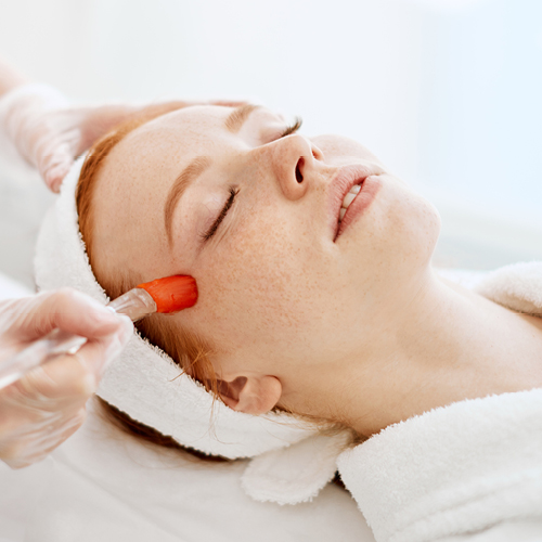 chemische peeling rosacea