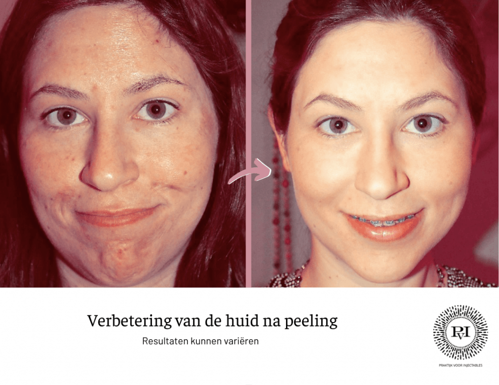 chemische peeling tca