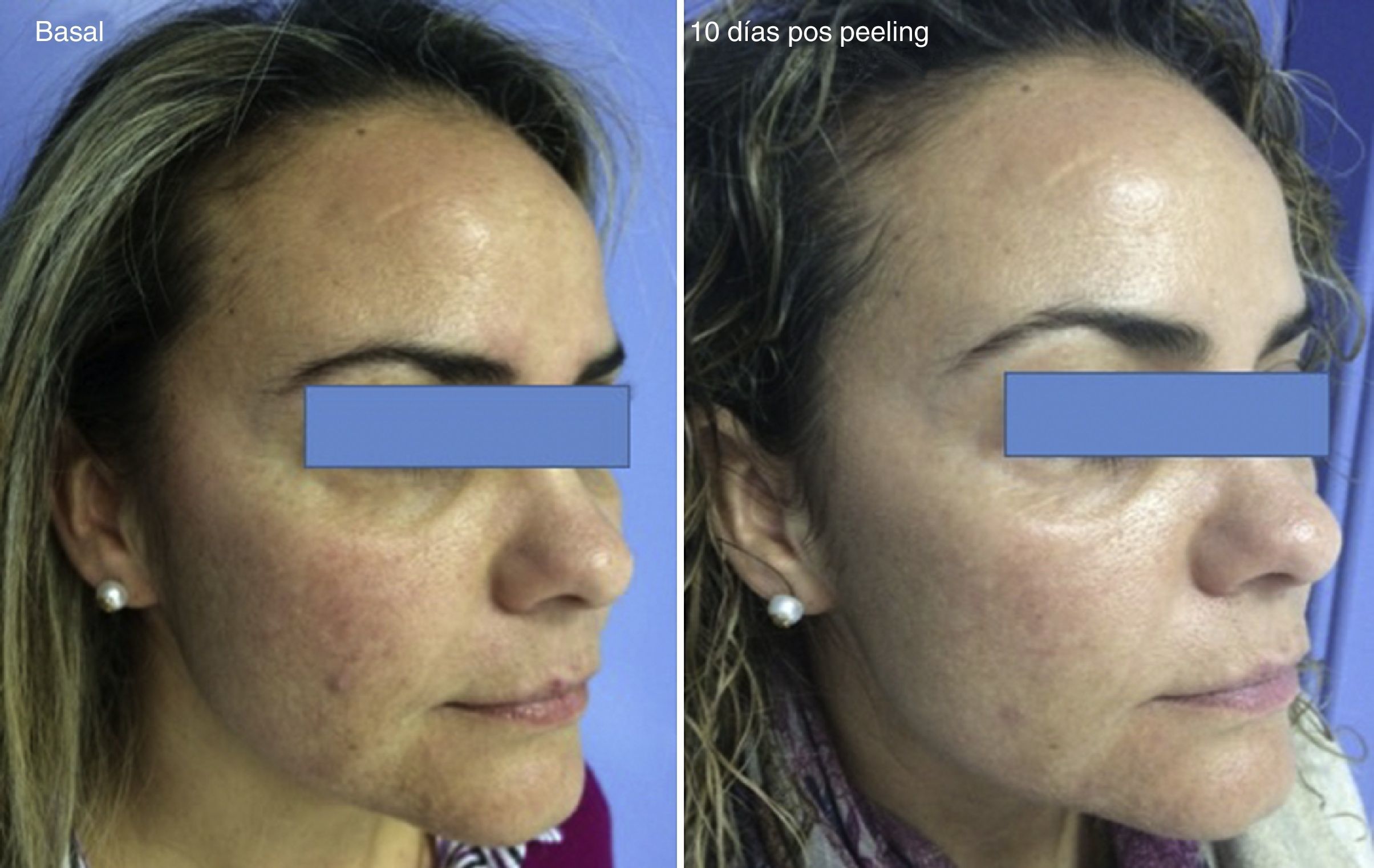 peeling con acido salicilico