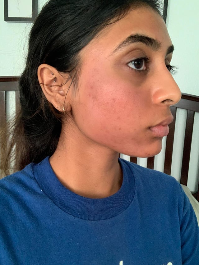 peeling donkere huid