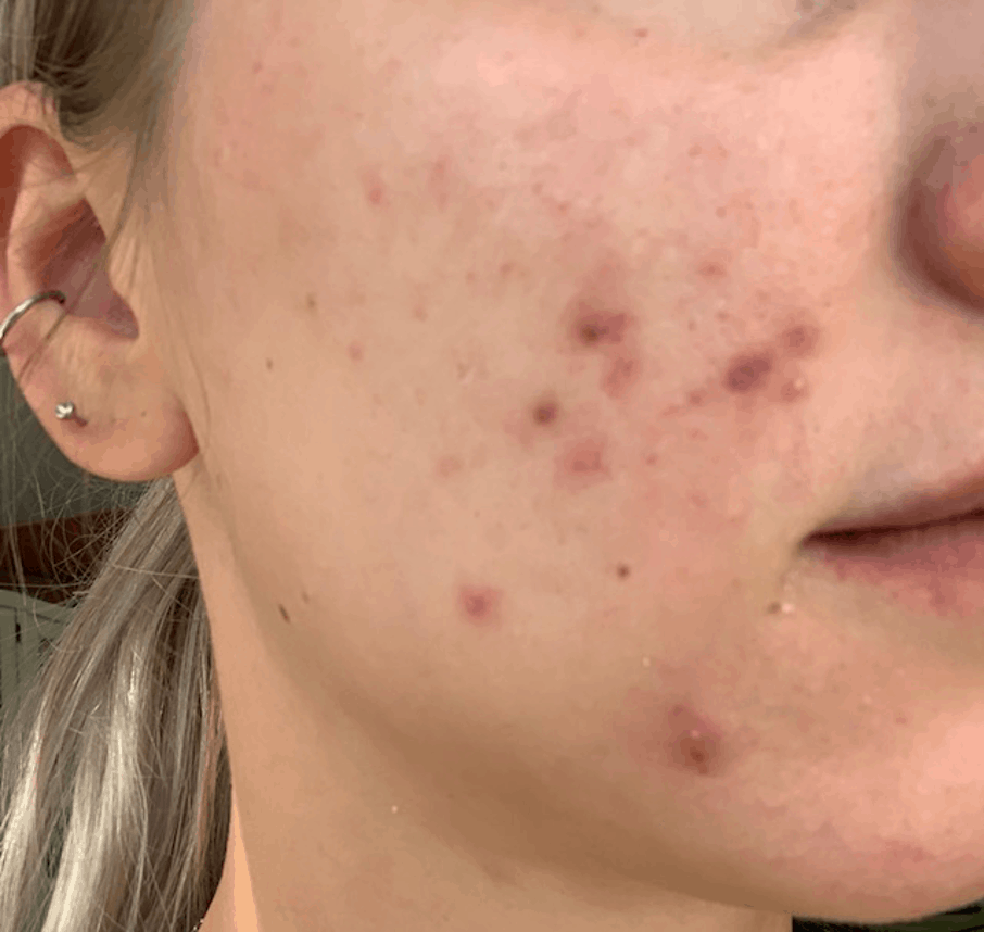 peeling gezicht acne