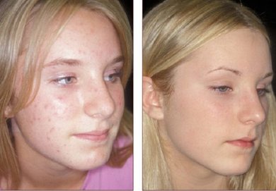 peeling tegen acne