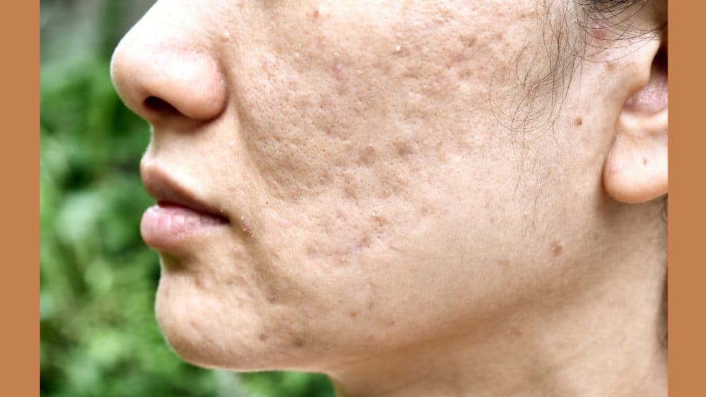 peeling tegen acne littekens