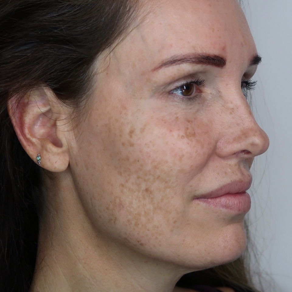 peeling thuisgebruik