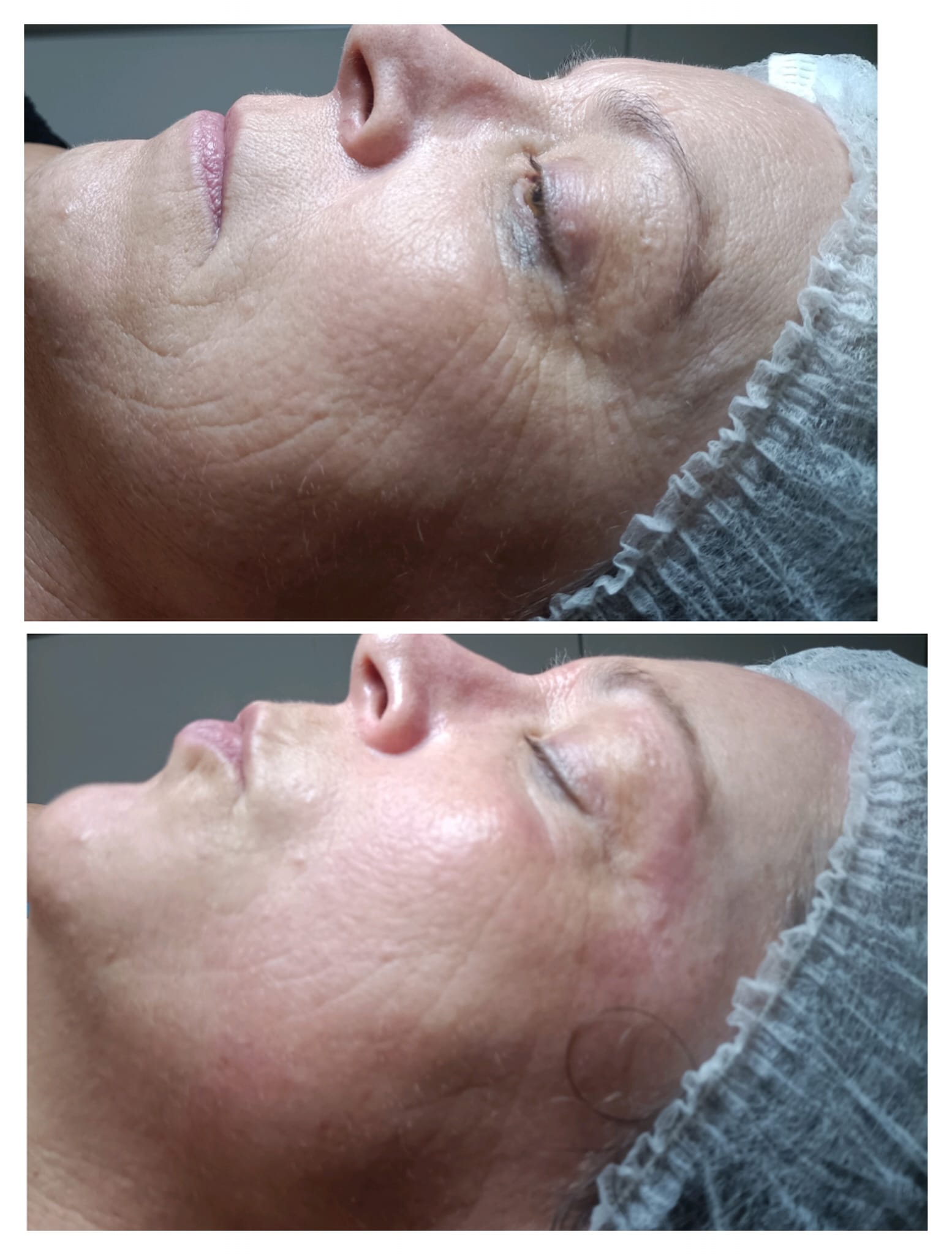 beste huidverjonging